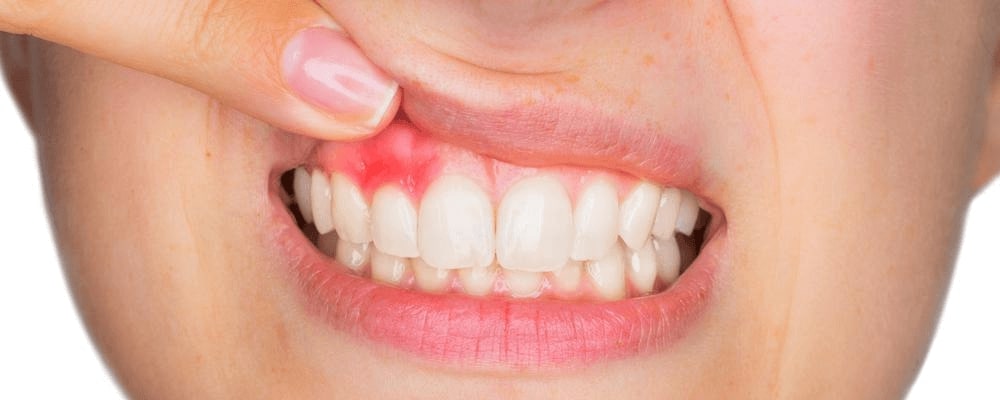 Types of Gum Disease: Stages, Factors and Related Conditions
